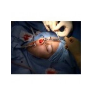 Catálogo Rinoplastia